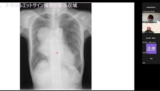 シルエットサイン陽性